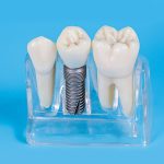 Dental Implants in Cedar Park, TX, Cedar Park dental implants
