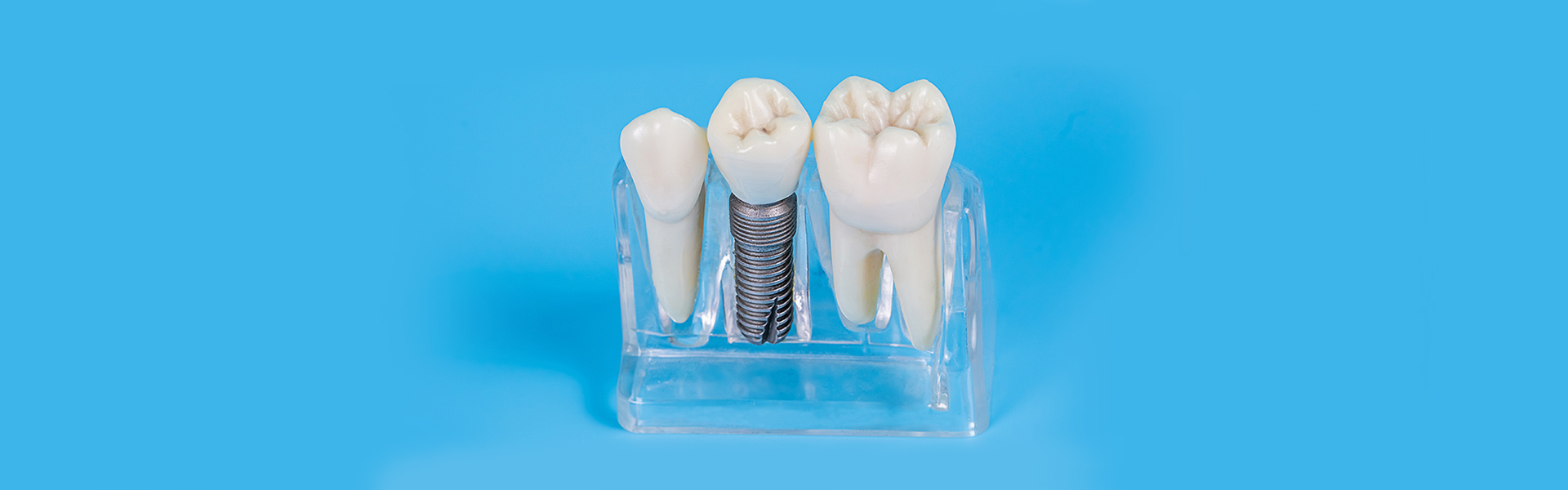 Dental Implants in Cedar Park, TX, Cedar Park dental implants