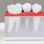 dental implants in paoli, dental implants near me, dentist near me